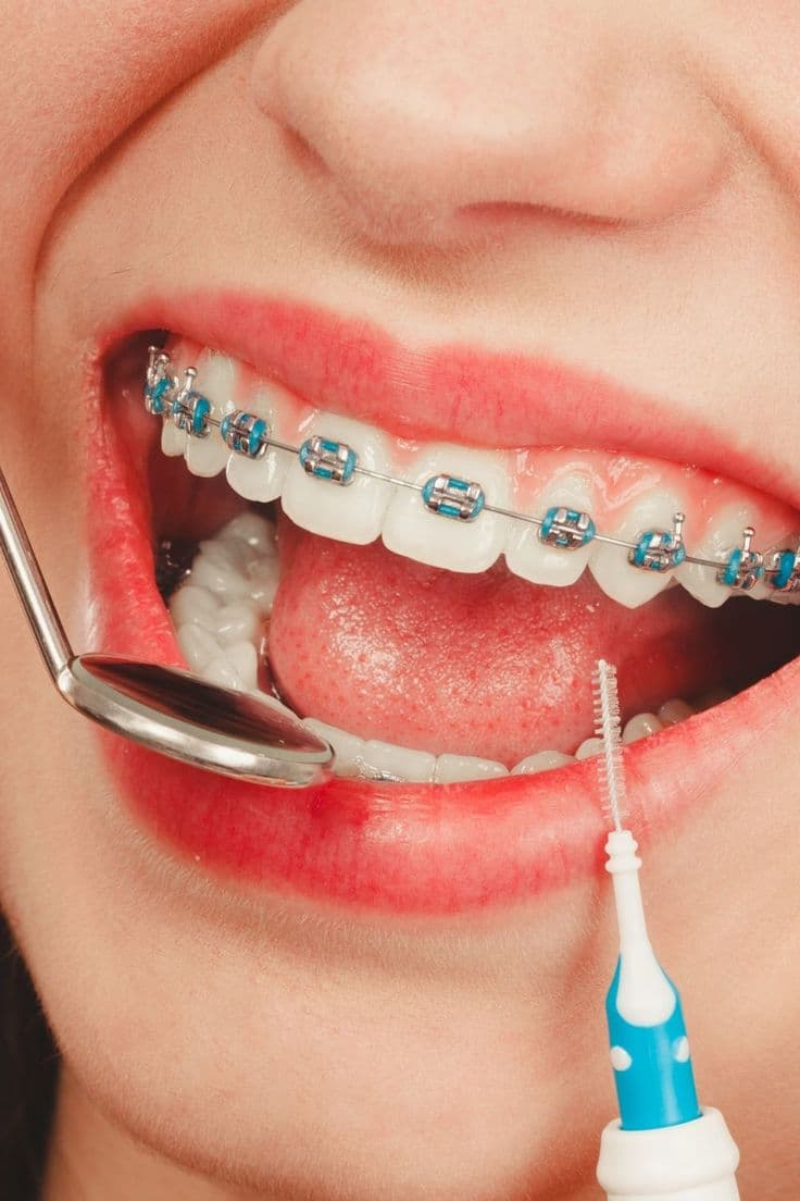 Alinear mis dientes