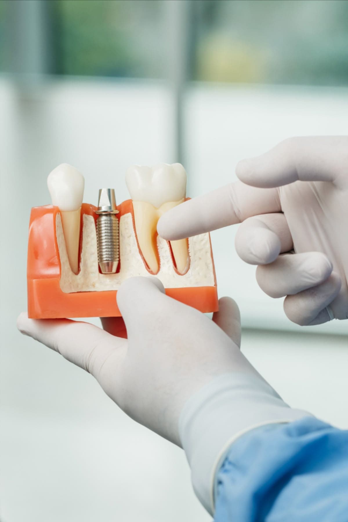 Implantes dentales en Riedent