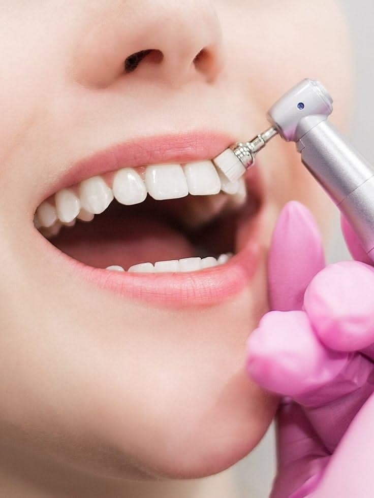Limpieza dental profesional en Riedent